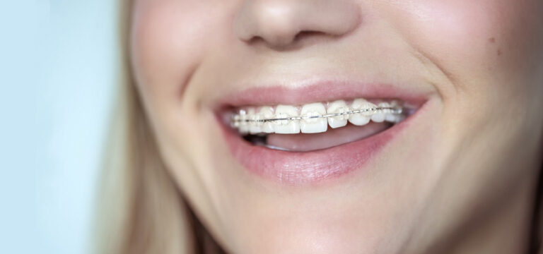 Close up of woman smiling with ceramic braces