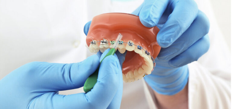 Close up of braces wires being cleaned and maintained