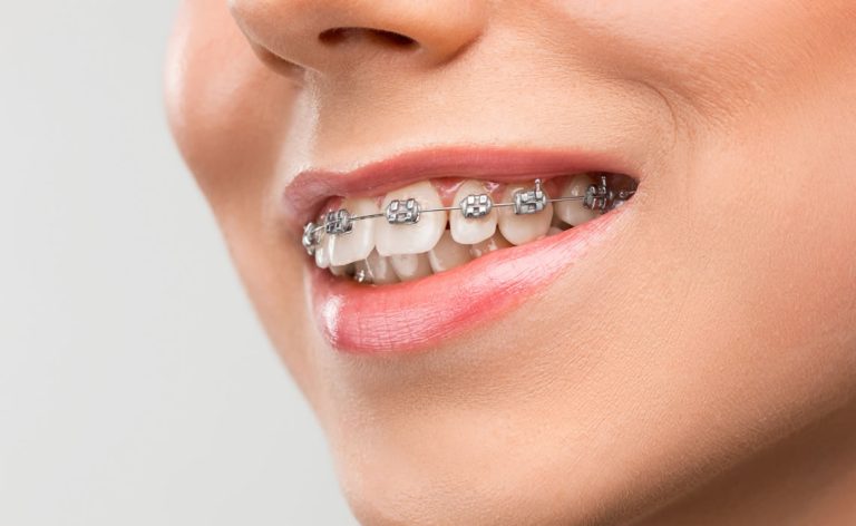 The Difference between clear braces and metal braces cost pros & cons