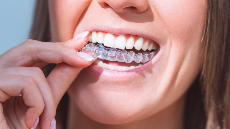 How Long Does Invisalign Treatment Take