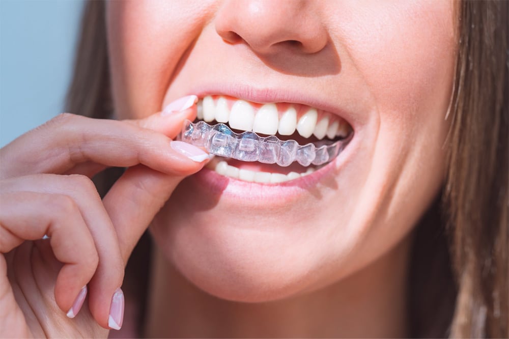 How Long Does Invisalign Treatment Take