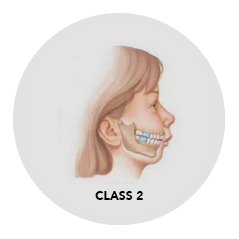Side portrait of class 2 bite before braces treatment