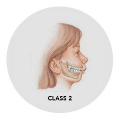 Side portrait of class 2 bite before braces treatment