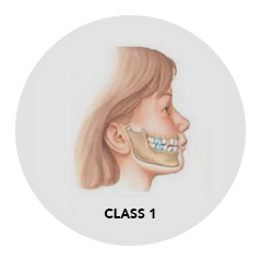 Side portrait of class 1 bite before braces treatment