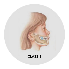 Side portrait of class 1 bite before braces treatment