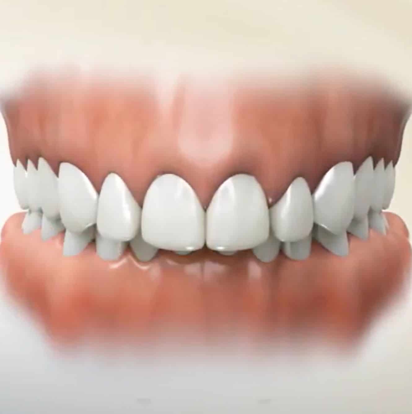 Overbites - Why Do They Need Correction? - Peak Orthodontics
