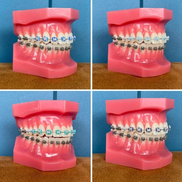 braces colours to choose from