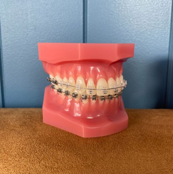 Braces with ceramic braces on the top and metal braces on the bottom teeth